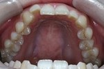 インビザライン治療例3-矯正治療前